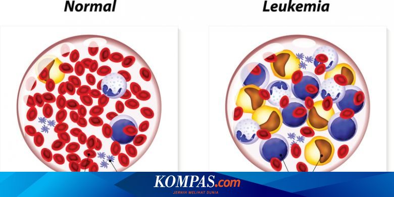 Leukemia simptom Symptoms of