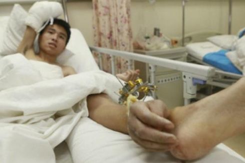 Dokter China, Pasang Tangan yang Putus di Kaki Korban