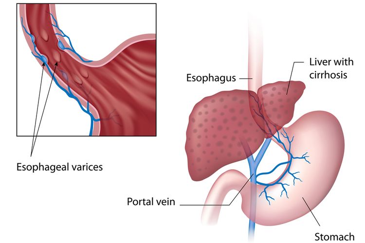 Ilustrasi Varises Esofagus