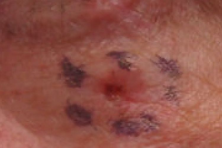 Chef Gordon Ramsay mengidap kanker kulit basal cell carcinoma (karsinoma basal sel). Apa saja gejalanya dan faktor risikonya? Simak selengkapnya.