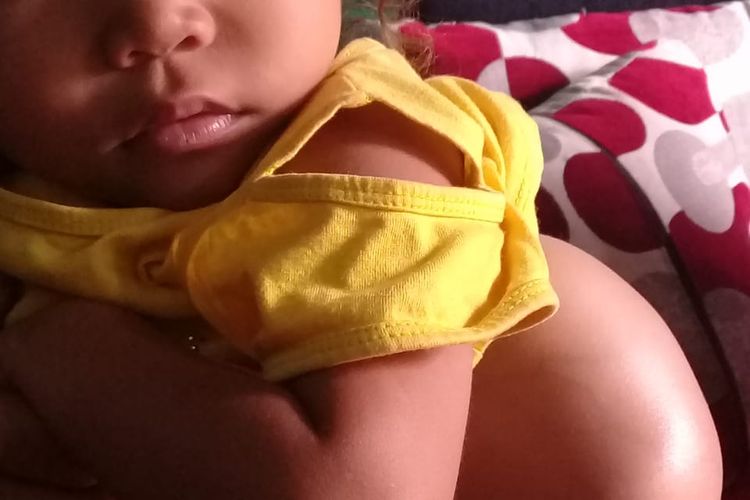 Foto : Yohana Calista Teren, bayi berusia 3 tahaun, asal Wudi, Desa Wudi, Kecamatan Cibal, Kabupaten Manggarai, NTT, menderita tumor di punggung kirinya. 
