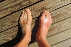 Apa Ciri-ciri Asam Urat di Kaki? Kenali 6 Gejalanya Berikut...