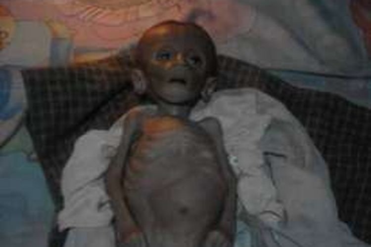 Farel, bayi asal Kefemanenanu, NTT, meninggal akibat menderita gizi buruk.
