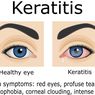 Keratitis