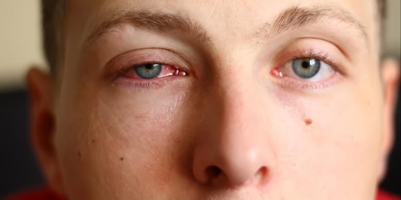 Ilustrasi mata merah. Penyebab konjungtivitis atau mata merah yang umum meliputi alergi, infeksi bakteri, dan infeksi virus.