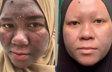 Perjuangan Nur Tya menyehatkan wajahnya kembali mulai menunjukkan hasil.