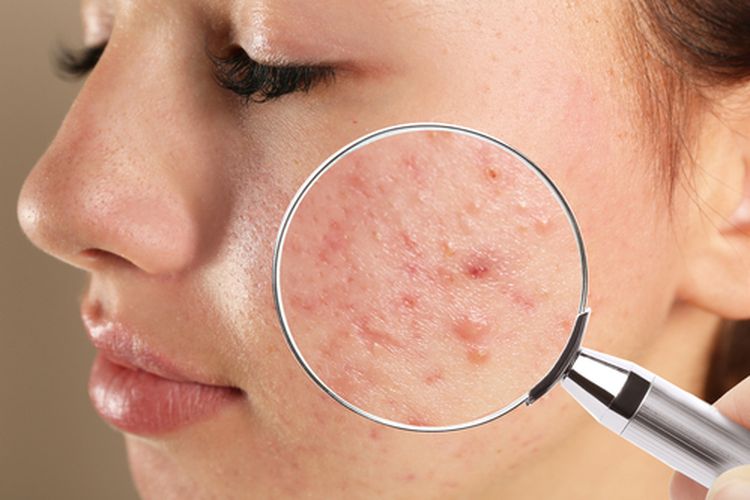Jerawat adalah salah satu contoh penyakit kulit yang paling umum terjadi. 