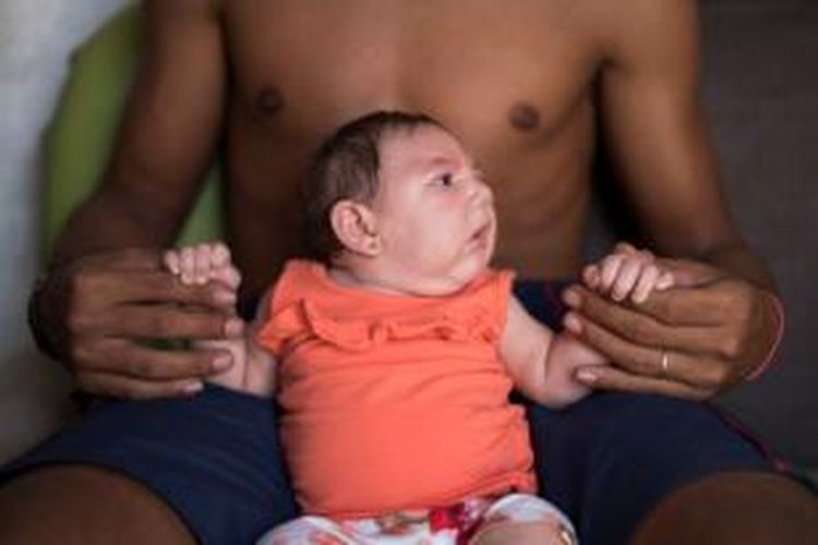 Bayi Luzia asal Brasil menderita mikrosefali karena diduga terinfeksi virus ZIka yang ditularkan melalui nyamuk.