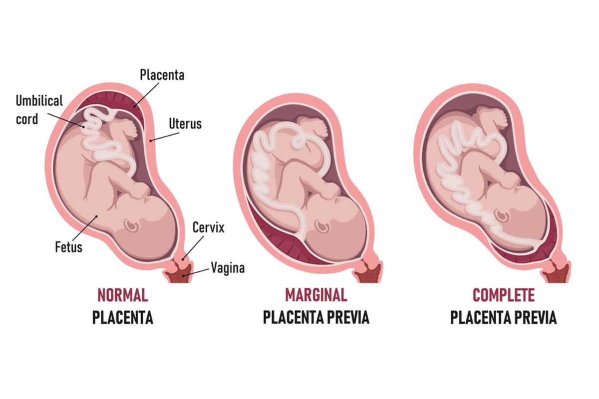 Ilustrasi plasenta previa