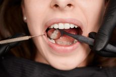 Karang Gigi Lepas Sendiri, Baik atau Justru Berbahaya?