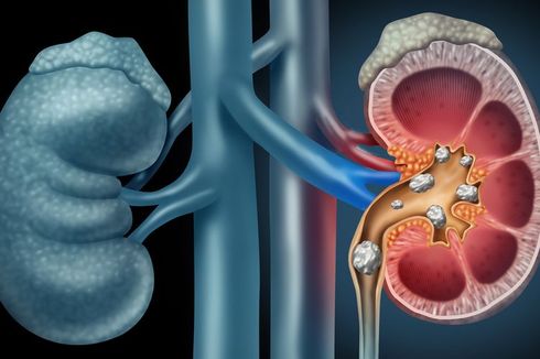 Tes Apa yang Digunakan untuk Diagnosis Batu Ginjal?