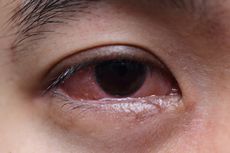 Dokter RSA UGM: Begini Cara Mencegah Penularan Mata Belekan