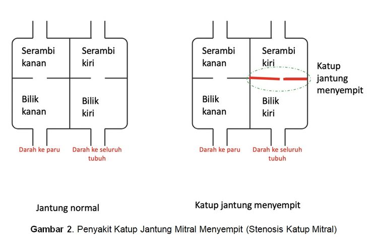 Penyakit Katup Jantung Mitral Menyempit (Stenosis Katup Mitral)