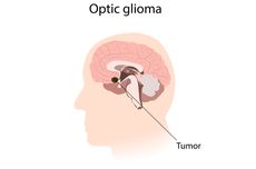 Optik Glioma