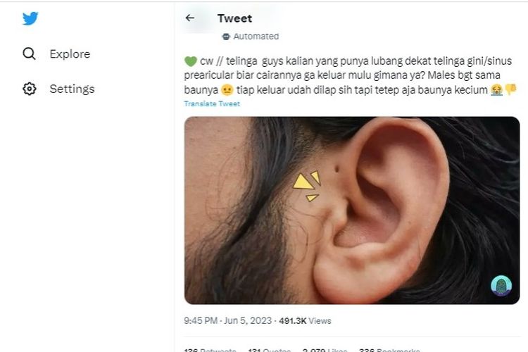 Ramai soal lubang kecil dekat telinga yang mengeluarkan cairan dan berbau.