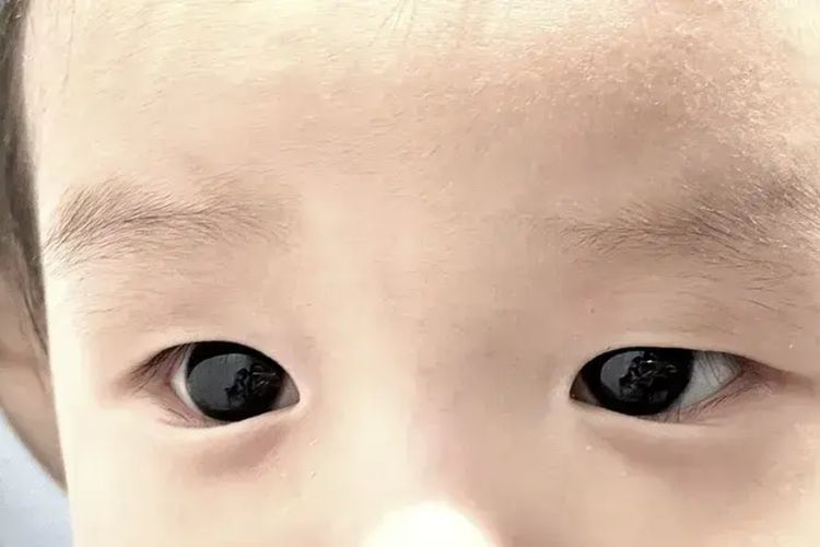 Bola mata seorang bocah di Jepang yang masih berwarna hitam sebelum menjalani perawatan infeksi virus corona. Bola mata inilah yang kemudian berubah menjadi biru, ketika si bayi menjalani perawatan. 