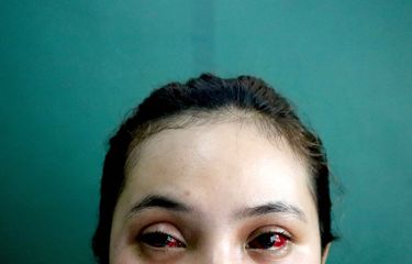 Tragedi Kanjuruhan: Mata Merah Keviana Baru Bisa Sembuh 1-2 Bulan