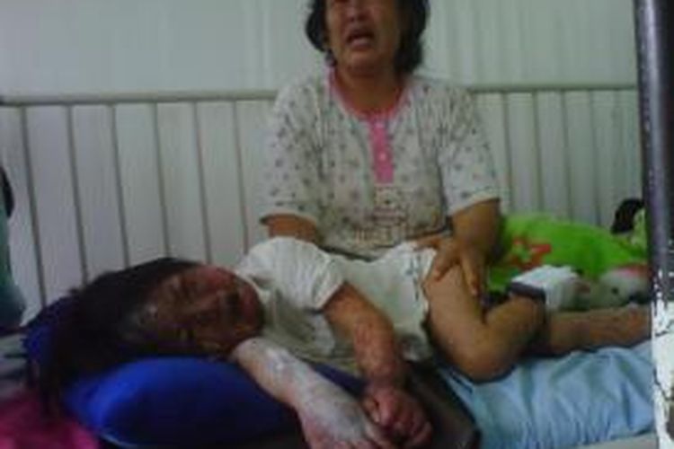 Ananda Putri Pamungkas (3) anak pasangan Supri (45) dan Rina (40) warga Lingkungan Junggul, Kecamatan Bandungan, mengalami melepuh disekujur tubuhnya diduga akibat alergi obat.