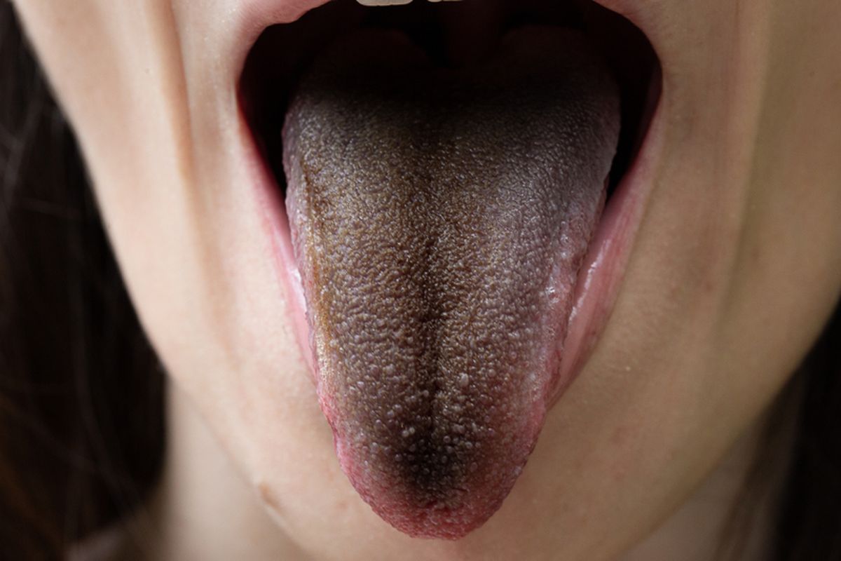 Ilustrasi lidah berbulu sebagai salah satu bentuk masalah lidah yang bisa dialami seseorang.