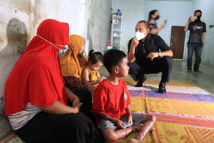 Gubernur Sumut, Edy Rahmayadi menjenguk Haikal dan Zakira, dua bocah penderita penyakit kulit aneh di Medan, Minggu (4/7/2021).