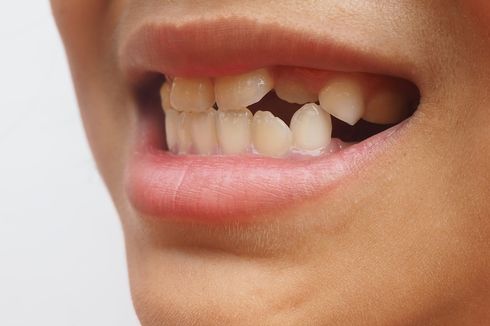 Kenapa Gigi Kuning Susah Putih? Berikut 10 Penyebabnya