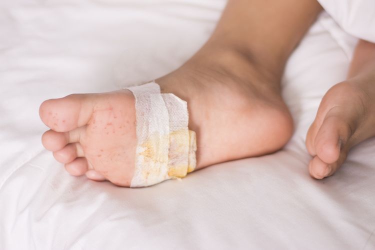 Ilustrasi luka di kaki penderita diabetes. Penderita diabetes sering kali mengalami luka di kaki. Luka ini perlu diobati dengan membersihkan luka setiap hari dan menggunakan obat topikal.