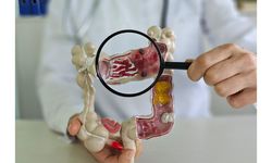 Tak Hanya Pola Makan Buruk, Ini Sejumlah Faktor Penyebab Utama Kanker Usus