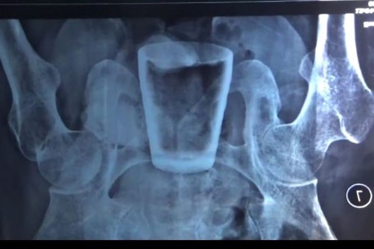 Hasil foto rotgen tubuh warga Jember yang berisi gelas pecah di bagian atas 