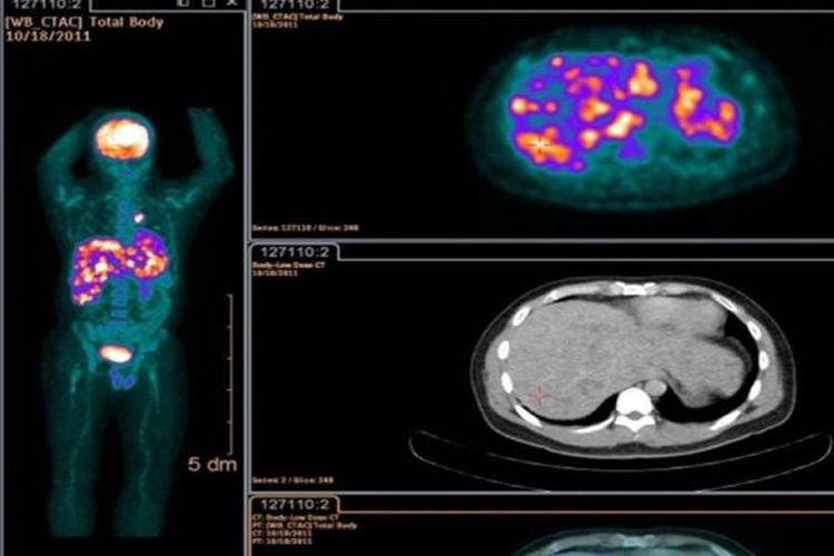 Pemindaian PET/CT adalah metode dalam kedokteran nuklir untuk mengetahui adanya sel-sel yang aktif didalam tubuh dengan cara pasien diberikan radioaktif perunut (FDG) kemudian dipindai dengan alat mesin Gamma Camera. 