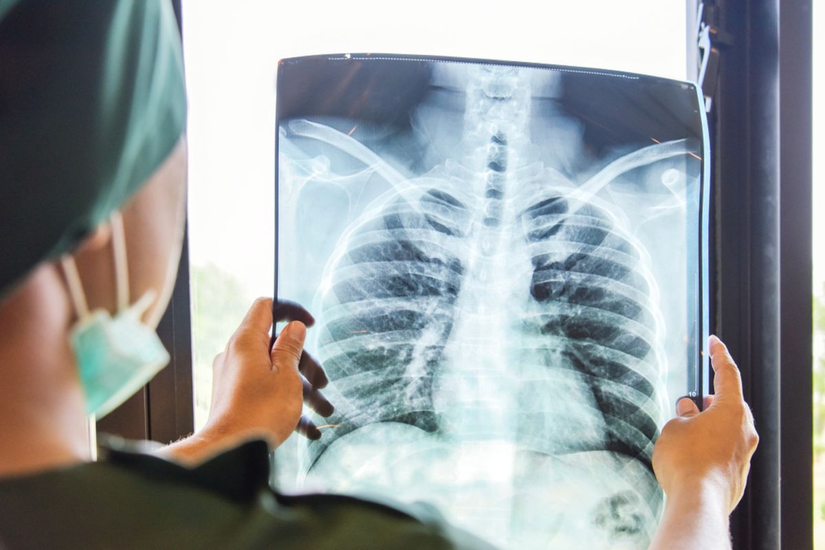 Ilustrasi rontgen paru-paru, ilustrasi TBC, ilustrasi x-ray, ilustrasi rontgen.