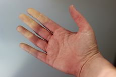 Penyakit Raynaud