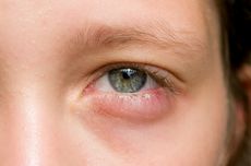 9 Penyebab Mata Bengkak dan Cara Mengatasinya