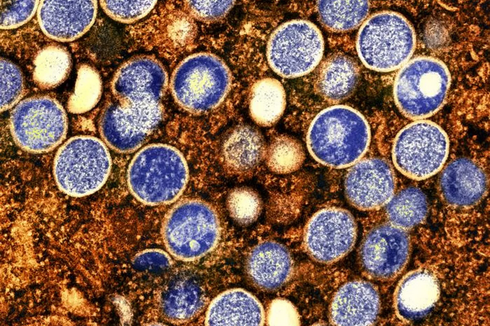 Gejala Alaskapox, Virus Langka yang Catatkan Kematian Pertama di Dunia