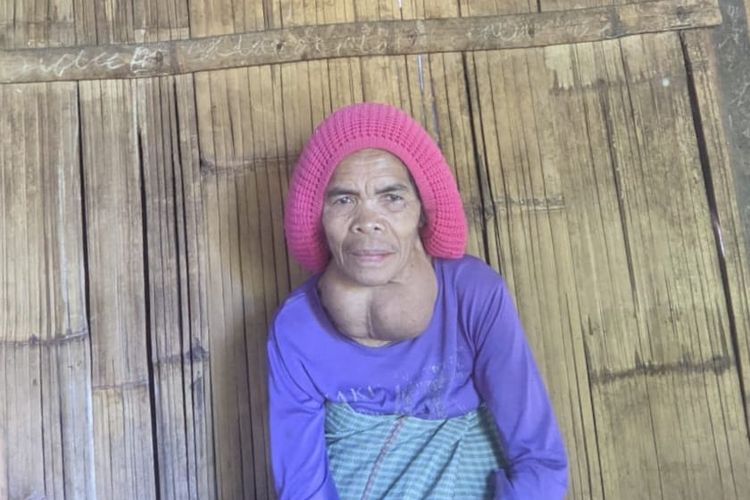 Kisah Pilu Anastasia Lija, 35 Tahun Melawan Penyakit Gondok Sambil Berjuang Hidupi Anak
