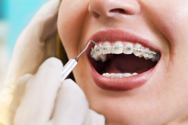 Apakah pasang kawat gigi ditanggung bpjs kesehatan?