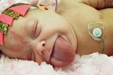 Lidah Bayi Menjulur Selama 16 Bulan, Kini Sudah Bisa Tersenyum