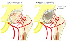 Avascular Necrosis