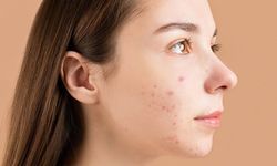 Ingin Tampil Flawless Bebas Jerawat? Ini 3 Tip Perawatan Kulit Sensitif dari Doviqa Skincare