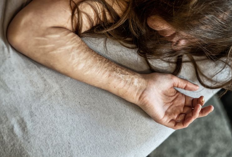 Kriminolog: Penyiraman Air Keras Dianggap Cara Murah dan Mudah Melukai Korban