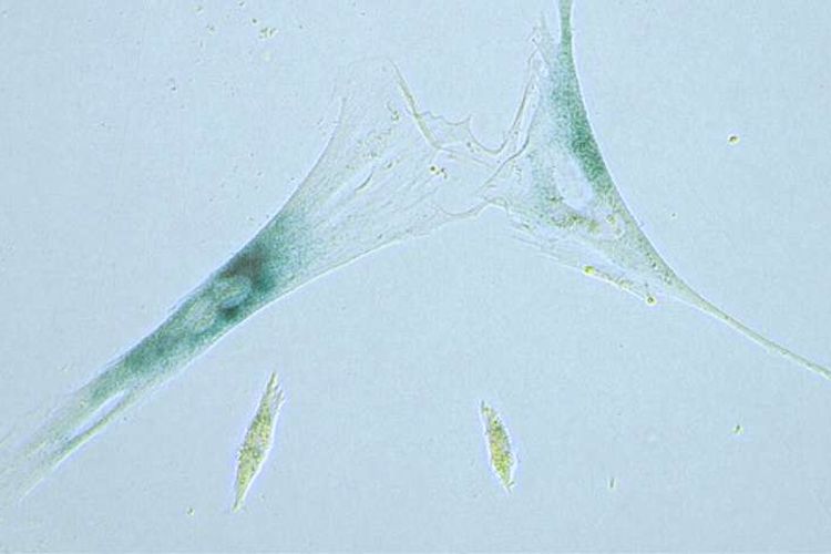 Dua sel fibroblast yang telah mengalami senesens dan menjadi zombie. Di bawahnya, dua sel fibroblast normal.
