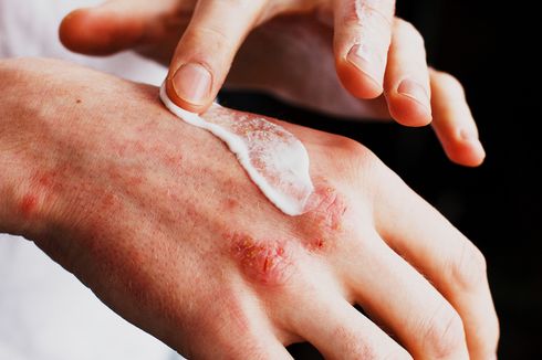 Mengenali Penyebab dan Cara Mengatasi Neurodermatitis