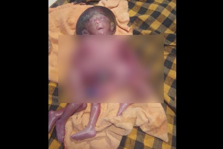 Inilah bayi berkepala satu, bertubuh dua serta bertangan dan berkaki empat yang lahir di Bihar, India. Bayi ini meninggal dunia beberapa saat setelah dilahirkan.