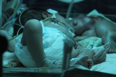 RSHS Siap Tanggung Kekurangan Biaya Bayi Kembar Parasit 