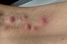 Hidradenitis Supurativa