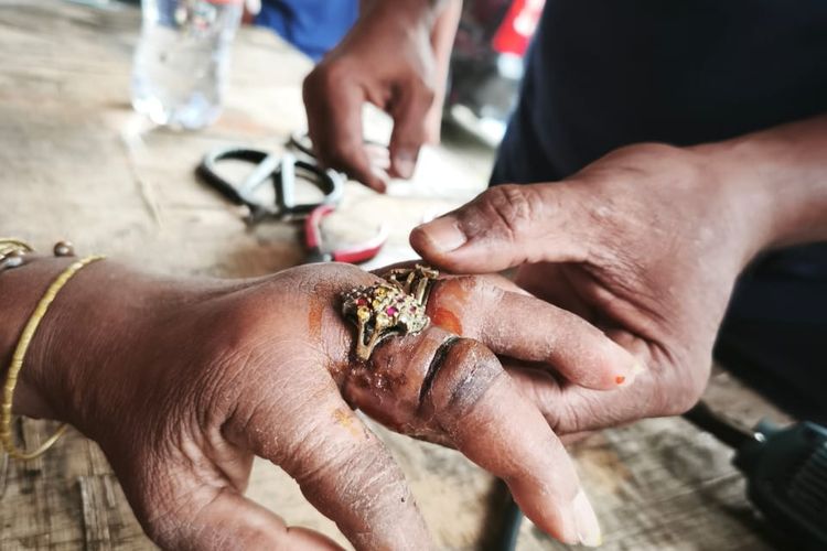 Cincin yang melekat di tangan ODGJ dan berusaha dilepas oleh petugas Damkar Sumenep, Jawa Timur. 