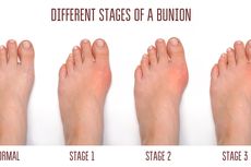 Bunion