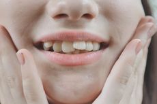 4 Cara Meluruskan Gigi yang Bengkok