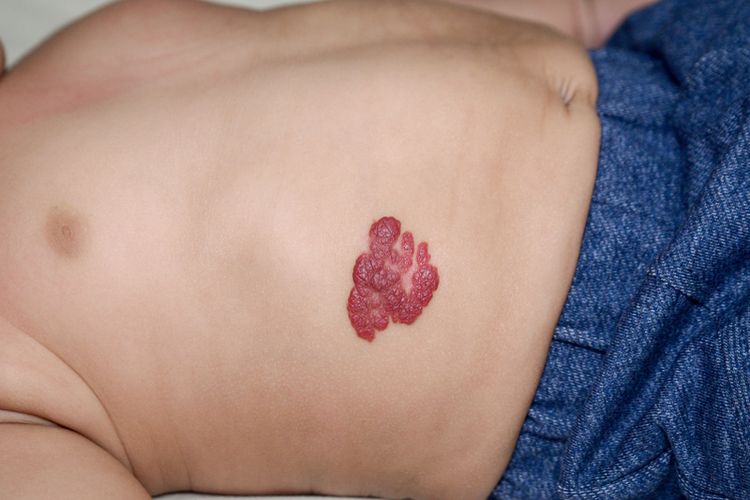 Ilustrasi hemangioma atau juga sering disebut tanda lahir merah