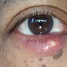 8 Penyebab Blefaritis (Radang Kelopak Mata) yang Perlu Diwaspadai