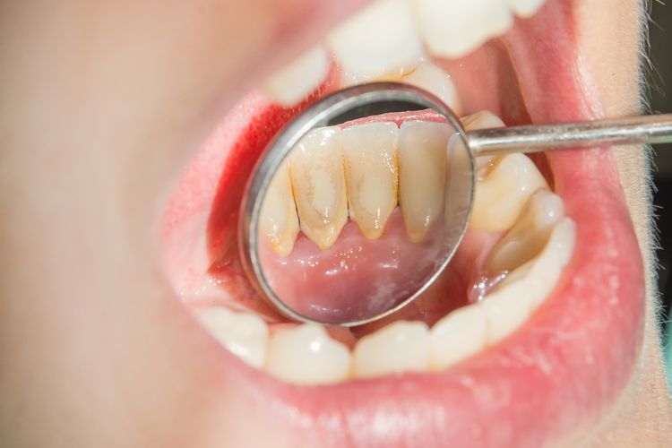 Karang gigi di gigi rahang bawah bagian dalam